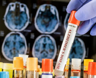Organoidi cerebrali per la ricerca sull'Alzheimer