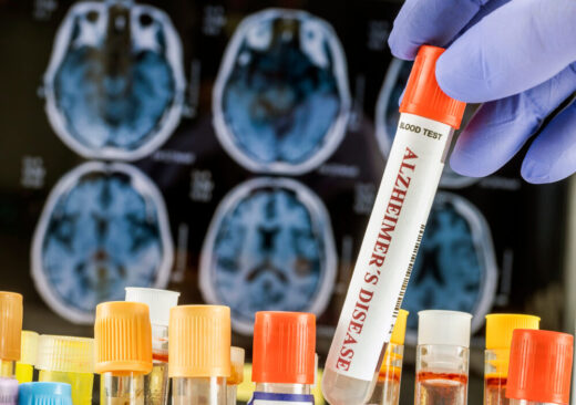 Organoidi cerebrali per la ricerca sull'Alzheimer