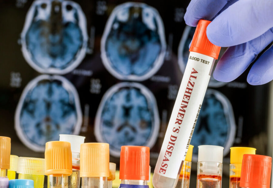 Organoidi cerebrali per la ricerca sull'Alzheimer